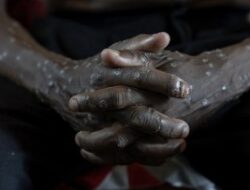 Makin Ngeri, Kematian Mpox ‘Cacar Monyet’ Ke Afrika Sudah Lebih Bersama 800 Peristiwa Pidana